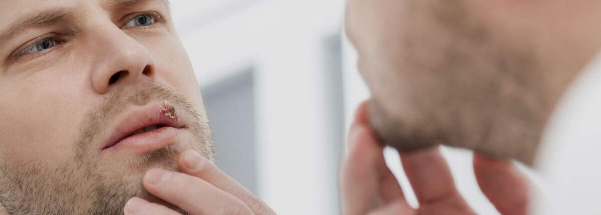 Hoe behandel je een lipblaasje (Herpes Labialis)?