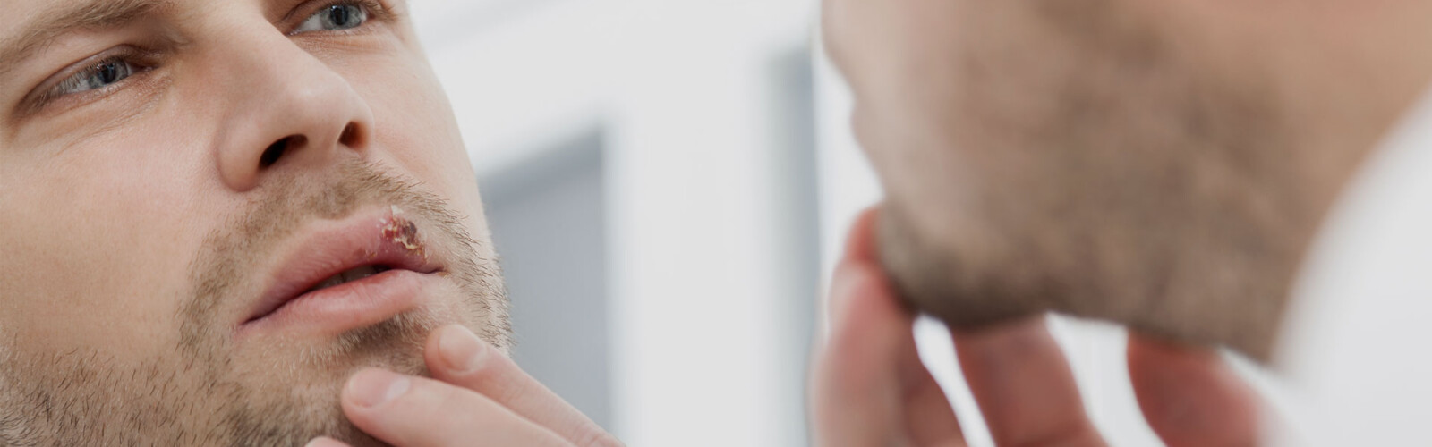 Hoe behandel je een lipblaasje (Herpes Labialis)?