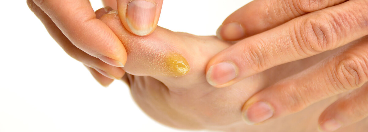 Hoe verwijder en behandel je eeltplekken?