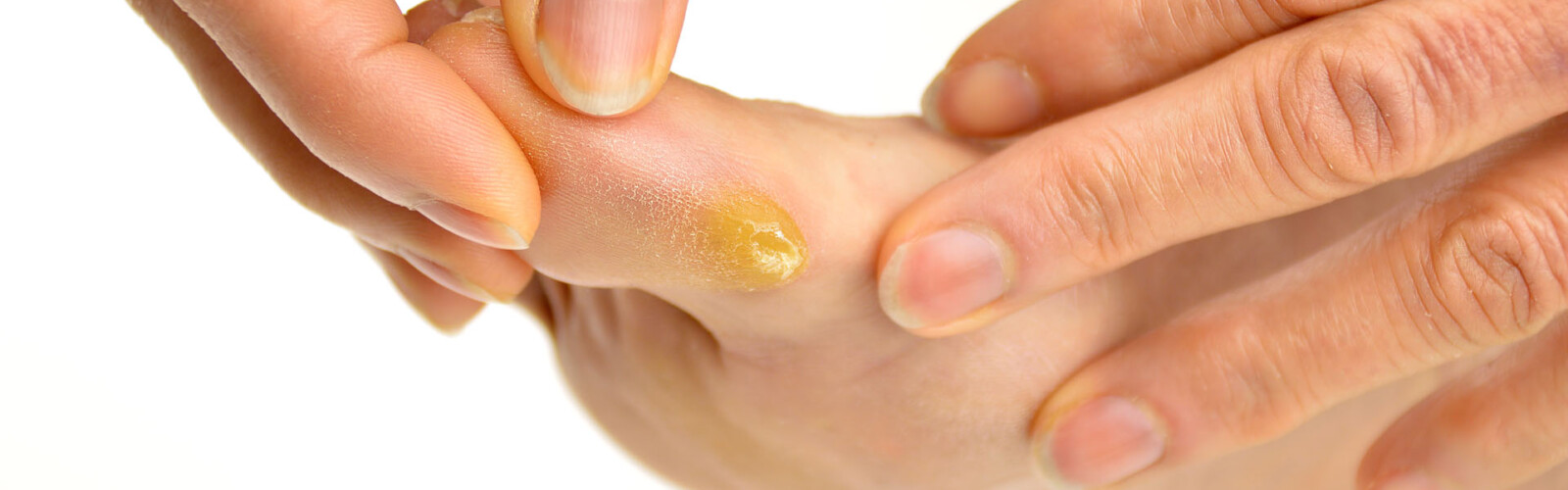 Hoe verwijder en behandel je eeltplekken?